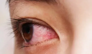 أسباب احمرار العين عند الاستيقاظ