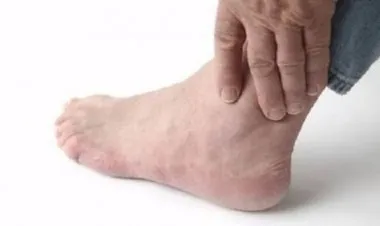 النقرس: العلامات المبكرة وكيف نتفاداه