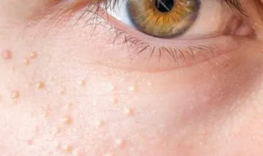 تعرف على طرق علاج حبوب الوجه تحت الجلد