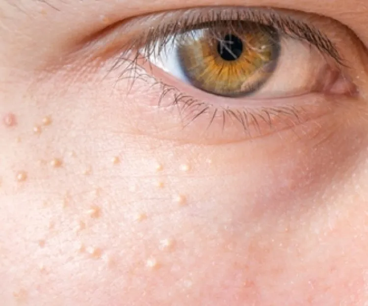 تعرف على طرق علاج حبوب الوجه تحت الجلد