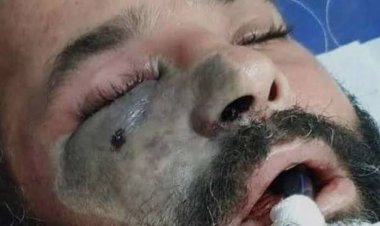 الفطر الأسود.. أعراضه وأنواعه خيارات العلاج وارتباطه بكورونا