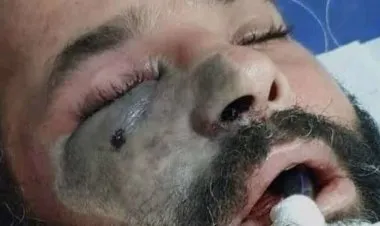 الفطر الأسود.. أعراضه وأنواعه خيارات العلاج وارتباطه بكورونا