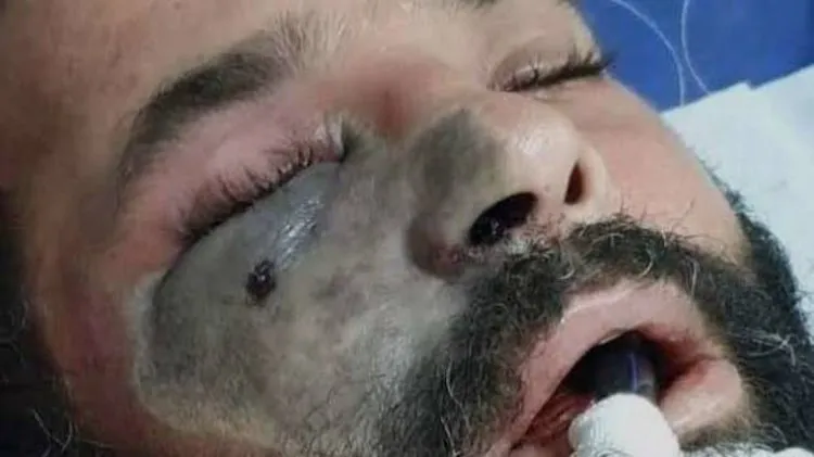 الفطر الأسود.. أعراضه وأنواعه خيارات العلاج وارتباطه بكورونا