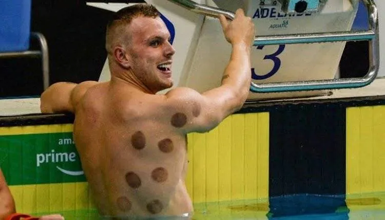 استخدام الرياضيين للحجامة يلفت الأنظار في أولمبياد طوكيو