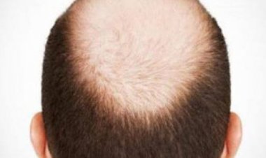 باحثون صينيون يصممون لصقة تعالج الصلع بأقل من شهر