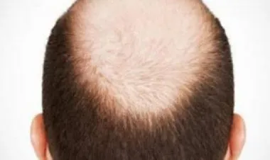 باحثون صينيون يصممون لصقة تعالج الصلع بأقل من شهر