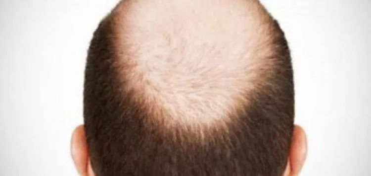 باحثون صينيون يصممون لصقة تعالج الصلع بأقل من شهر