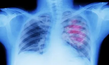 علامات تظهر في أصابعك قد تدل على سرطان الرئة!