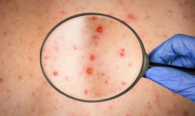 بعد شهر على جدري القرود.. عرض غريب يظهر لأول مرة