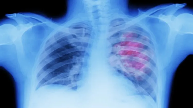 علامات تظهر في أصابعك قد تدل على سرطان الرئة!