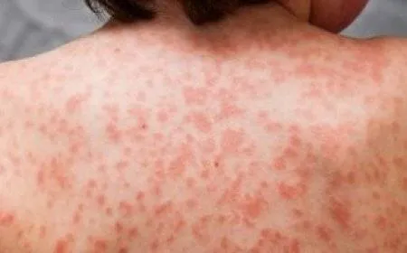 الأمراض التي قد يشير إليها الطفح الذي يصيب أكبر عضو في الجسم