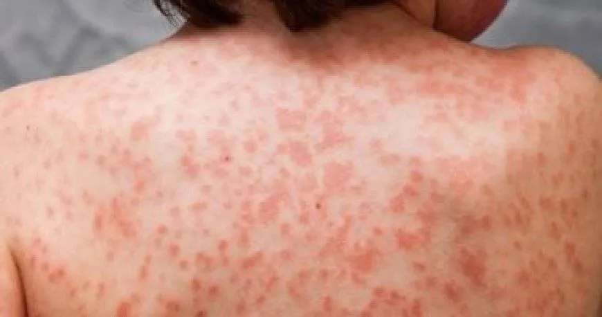 الأمراض التي قد يشير إليها الطفح الذي يصيب أكبر عضو في الجسم