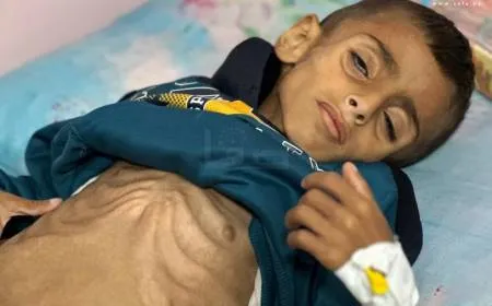 سوء التغذية يفتك بأطفال غزة