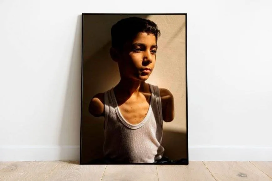 صورة طفل فلسطيني بترت ذراعاه تفوز بجائزة وورلد برس فوتو