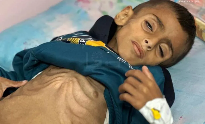 سوء التغذية يفتك بأطفال غزة