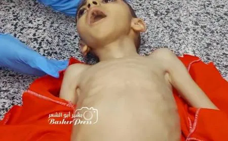 وفاة طفل بغزة جراء سوء التغذية