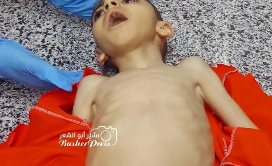 وفاة طفل بغزة جراء سوء التغذية