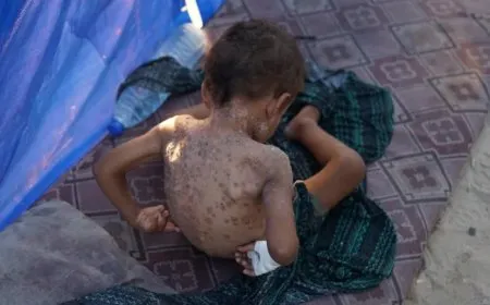 صحة غزة: تسجيل 337 إصابة بمرض السحايا بينها 259 حالة فيروسية والأعداد في ارتفاع سريع