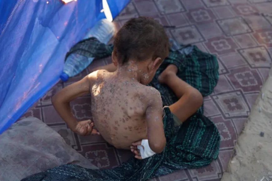 صحة غزة: تسجيل 337 إصابة بمرض السحايا بينها 259 حالة فيروسية والأعداد في ارتفاع سريع
