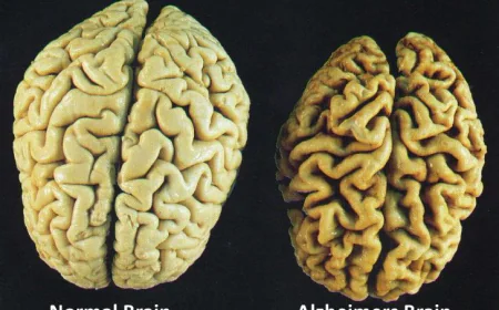 انفراجة طبية 2026: علاجات الأجسام المضادة تظهر نتائج مذهلة في وقف تدهور الزهايمر