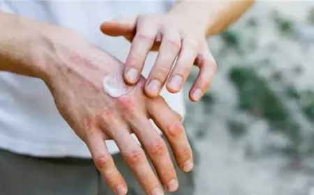 كريم الأكزيما الملوث ببكتيريا خطيرة يثير قلقا صحيا عالميا