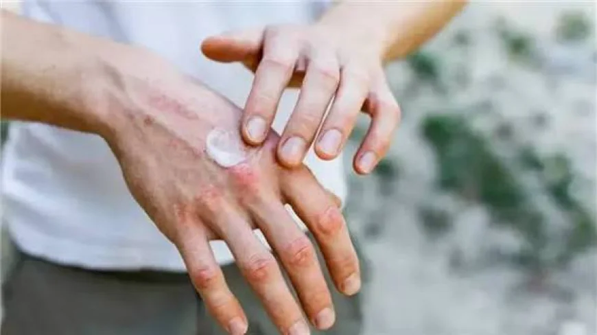 كريم الأكزيما الملوث ببكتيريا خطيرة يثير قلقا صحيا عالميا
