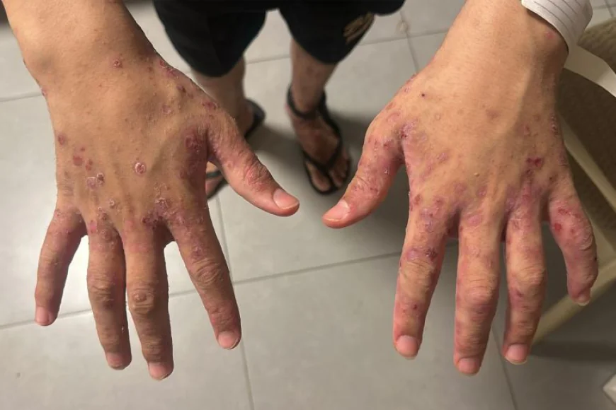 مرض الجرب في سجون الاحتلال يهدد حياة الأسرى الفلسطينيين
